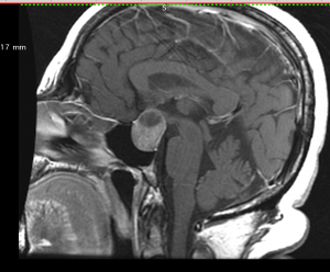 Προεγχειρητική MRI που αναδεικνύει το ευμεγέθες αδένωμα της υπόφυσης