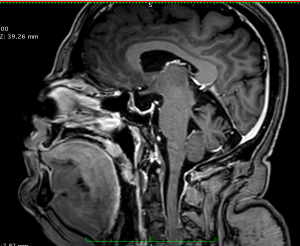 MRI υπόφυσης μετεγχειρητικά που αναδεικνύει την πλήρη αφαίρεση του αδενώματος