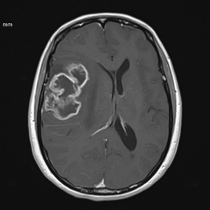 Προεγχειρητική MRI που αναδεικνύει το ευμεγέθες πολύμορφο γλοιβλάστωμα με σημαντικά πιεστικά φαινόμενα