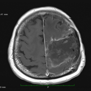 Μετεγχειρητική MRI που αναδεικνύει την πλήρη αφαιρεση του μηνιγγιώματος χωρίς καμία μετεγχειρητική αιμορραγία.