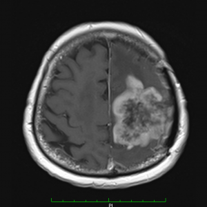 Προεγχειρητικη MRI που αναδεικνυει το ευμεγεθες αναπλαστικο μηνιγγιωμα
